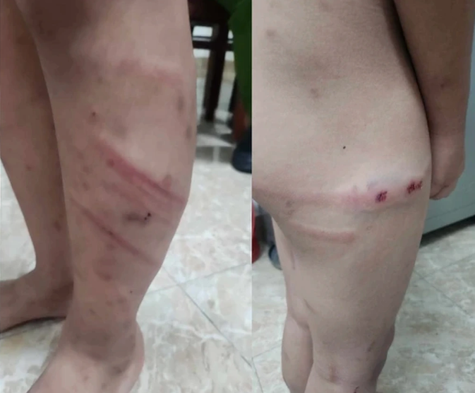 Vụ bạo hành bé trai 11 tuổi: Bắt bạn trai người mẹ- Ảnh 3.