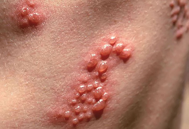 Nhiễm virus Herpes sau khi xăm l&agrave;m đẹp- Ảnh 1.