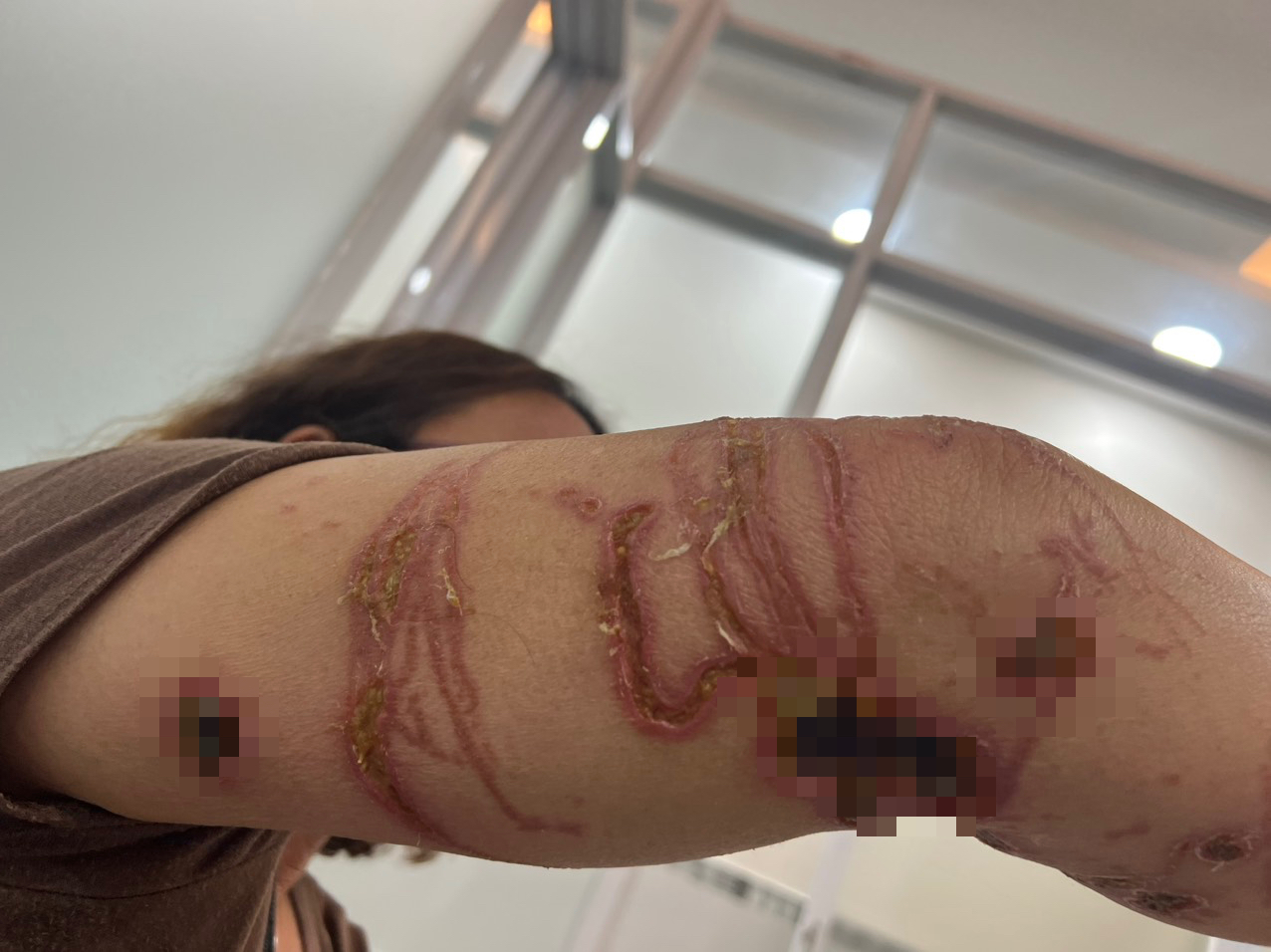 Hai người bị lở lo&eacute;t nặng sau khi đi tắm biển về- Ảnh 1.