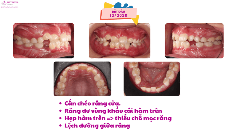 Chỉnh nha cho con - Việc l&agrave;m gi&aacute; trị, cả nh&agrave; hạnh ph&uacute;c- Ảnh 2.