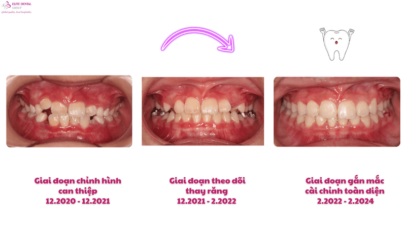 Chỉnh nha cho con - Việc l&agrave;m gi&aacute; trị, cả nh&agrave; hạnh ph&uacute;c- Ảnh 3.