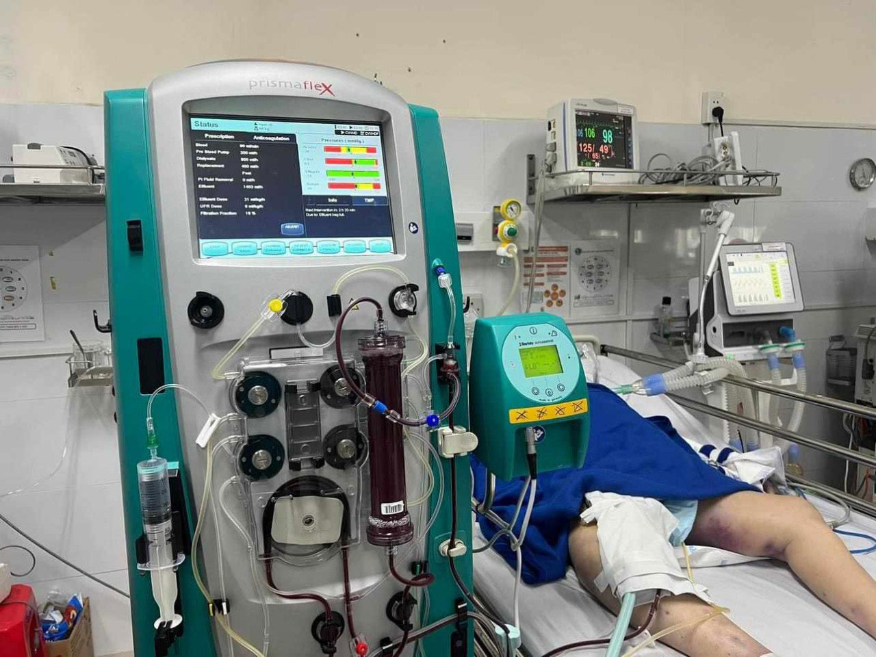 Bệnh nh&acirc;n được lọc độc chất sau 2 ng&agrave;y đ&atilde; qua cơn nguy kịch. (Ảnh do bệnh viện cung cấp)