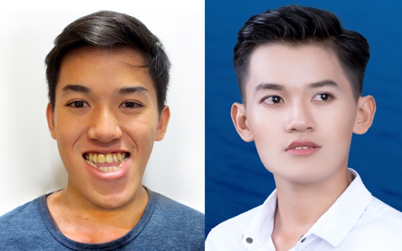 T&aacute;i tạo th&agrave;nh c&ocirc;ng v&ugrave;ng m&ocirc;ng cho người bị ung thư trực tr&agrave;ng - Ảnh 2.