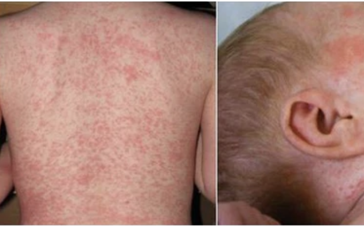 TP HCM: Ph&aacute;t hiện 60 ca nghi sốt ph&aacute;t ban sởi trong 1 tuần