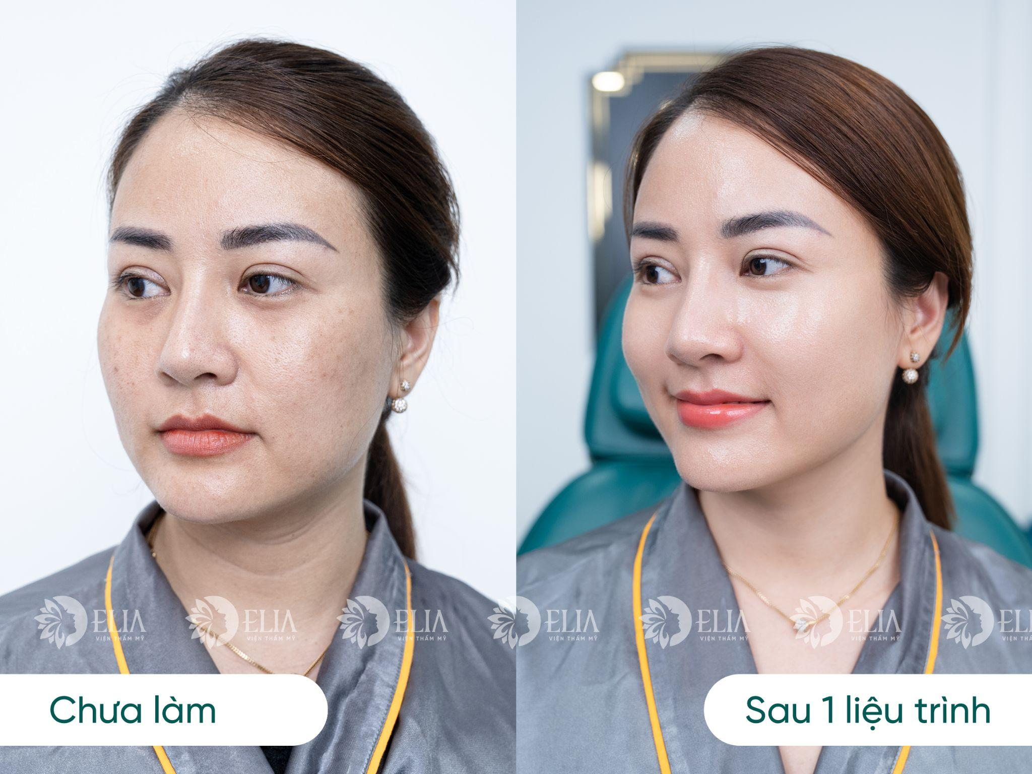 C&ocirc;ng nghệ trẻ h&oacute;a da kh&ocirc;ng nốt sần tại Viện thẩm mỹ quốc tế Elia- Ảnh 5.