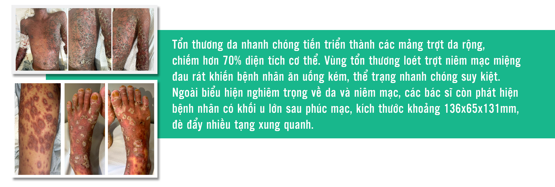 Hơn 200 ngày cứu bệnh nhân mắc bệnh da hiếm gặp- Ảnh 3.