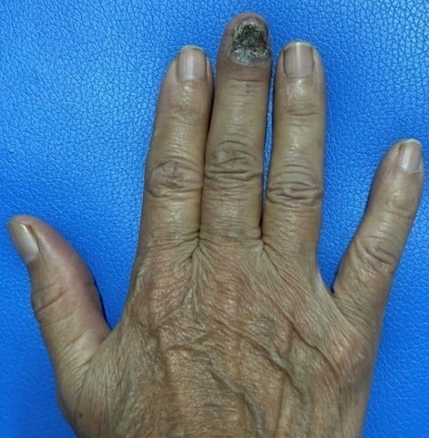 Những dấu hiệu ung thư da dễ g&acirc;y nhầm lẫn - Ảnh 5.