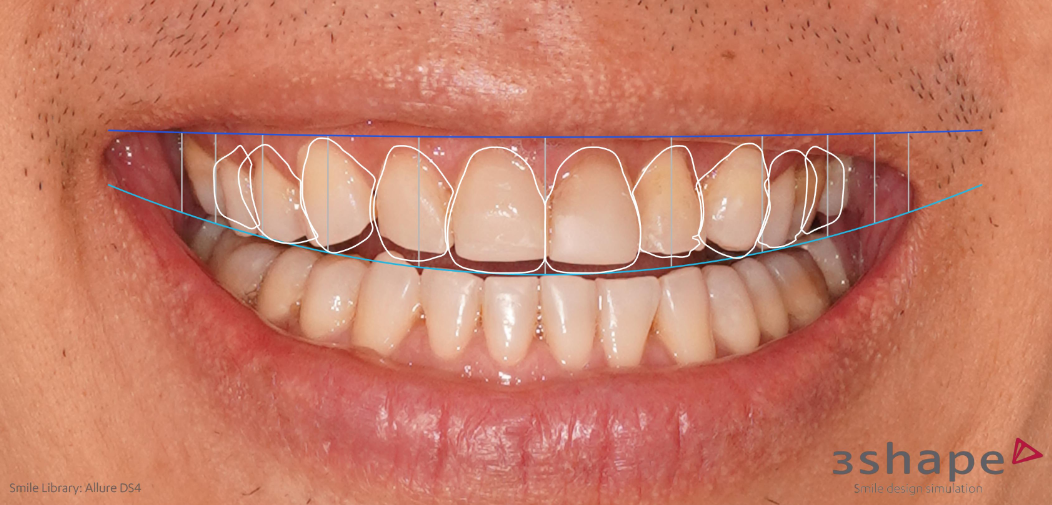 Cải thiện thẩm mỹ v&ugrave;ng răng cửa c&ugrave;ng d&aacute;n sứ Veneer- Ảnh 3.