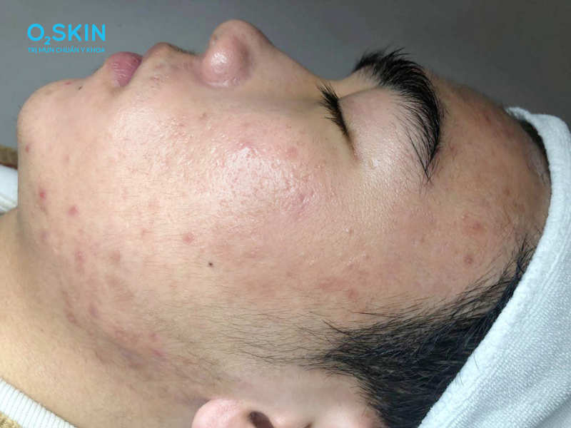 4 th&oacute;i quen xấu khiến nam sinh nổi đầy mụn ẩn tr&ecirc;n tr&aacute;n v&agrave; quai h&agrave;m- Ảnh 1.