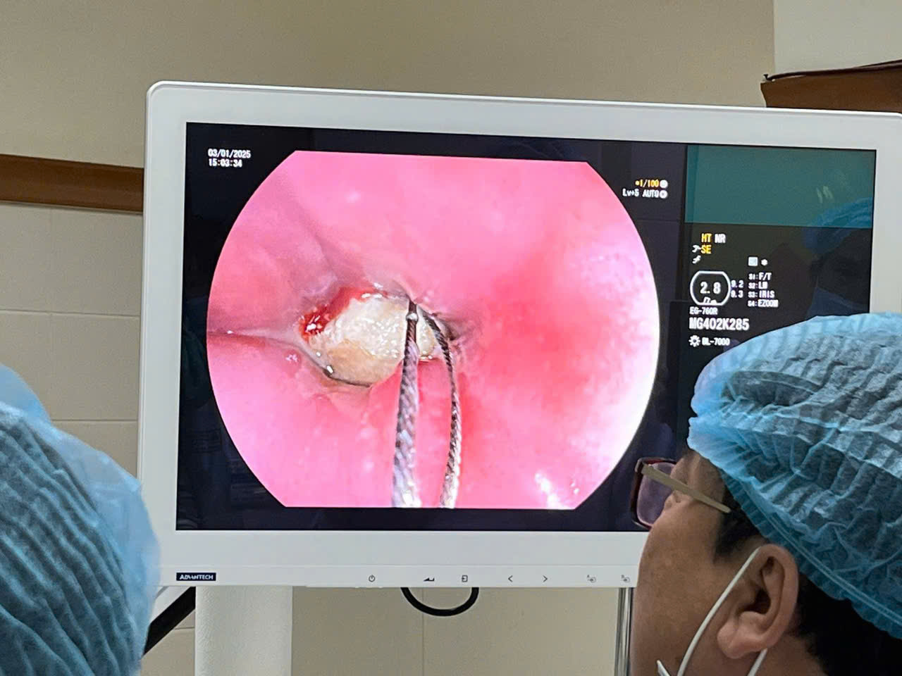 Nam thanh niên đau cổ họng dữ dội sau ăn cháo bởi lý do này- Ảnh 2.