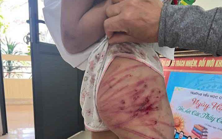 Vụ bé gái lớp 5 ở Hà Tĩnh bị bạo hành: Công an làm việc với người cha dượng