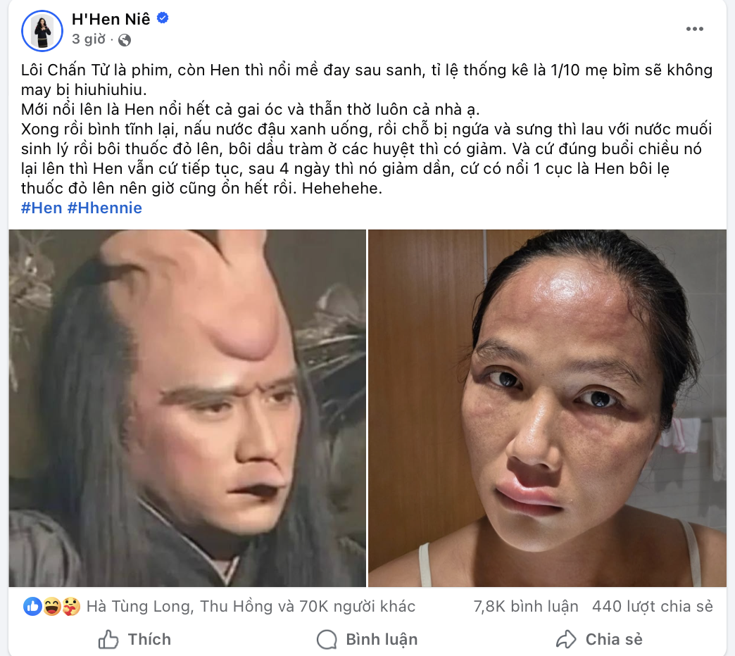 H'Hen Niê tiết lộ bị nổi mề đay sau sinh, bác sĩ nói gì về tình trạng này? - Ảnh 1.