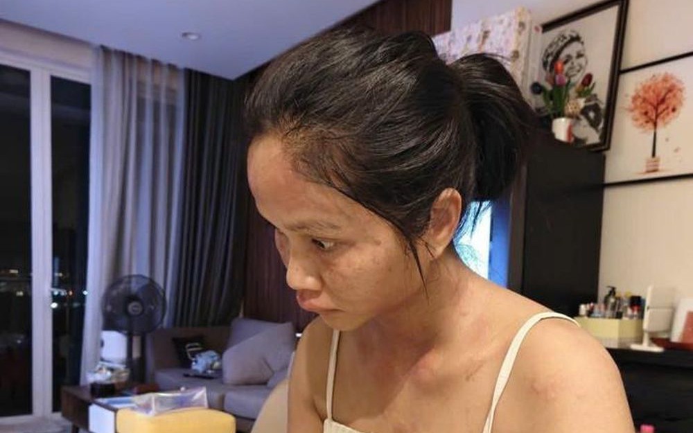 Gương mặt H'Hen Niê biến dạng, trấn an fan bớt lo