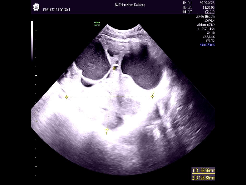 Bằng MRI, Thiện Nh&acirc;n Hospital ph&aacute;t hiện ung thư buồng trứng ở phụ nữ chưa từng sinh con - Ảnh 2.