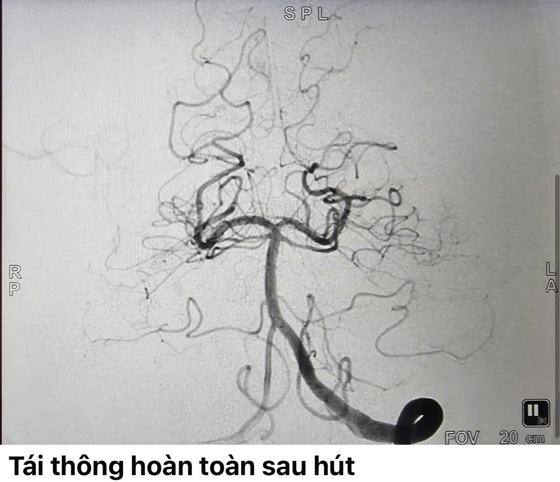 Người đàn ông bất ngờ đột quỵ khi đang uống bia - Ảnh 2.
