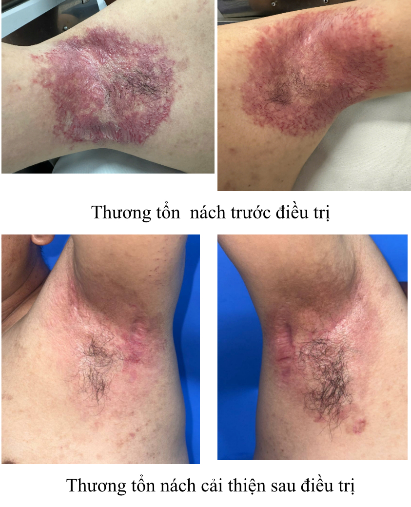Bất ngờ từ ca bệnh da di truyền hiếm gặp đáp ứng botulinum toxin - Ảnh 4.