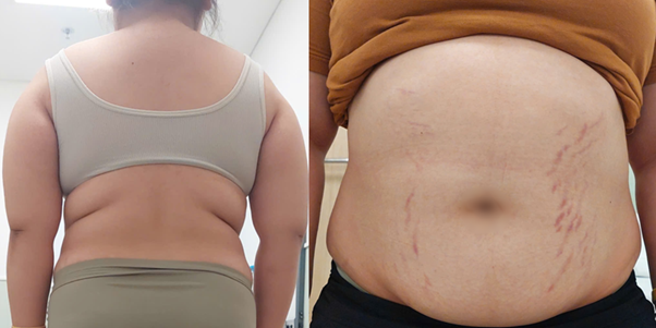 Bé gái 14 tuổi tăng 20kg, thấp đi 6cm vì căn bệnh siêu hiếm - Ảnh 1.