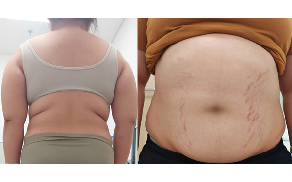 Bé gái 14 tuổi tăng 20kg, thấp đi 6cm vì căn bệnh siêu hiếm