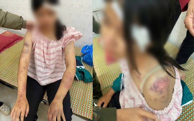 Thông tin mới vụ bé gái 13 tuổi bị tra khảo, đánh đập dã man, người chi chít vết thương