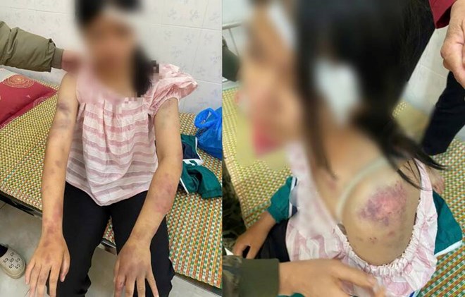 Thông tin mới vụ bé gái 13 tuổi bị tra khảo, đánh đập dã man, người chi chít vết thương - Ảnh 1.