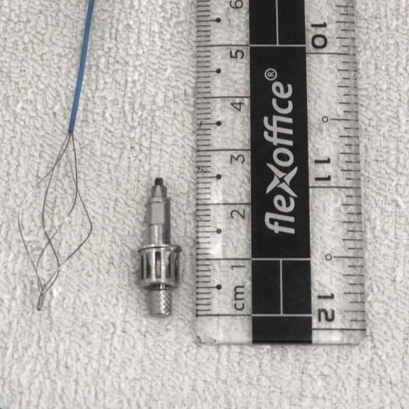 Sau trồng răng implant, bất ngờ phát hiện dị vật mắc trong phế quản