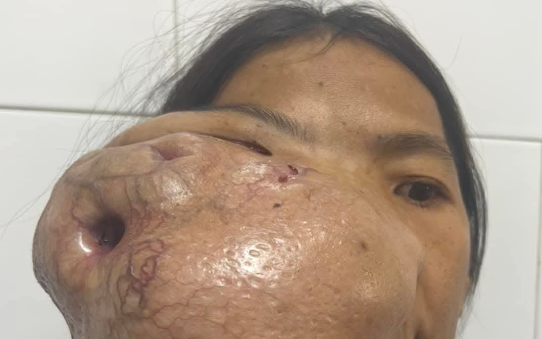 Người phụ nữ mang khối u khổng lồ trên mặt suốt nhiều năm