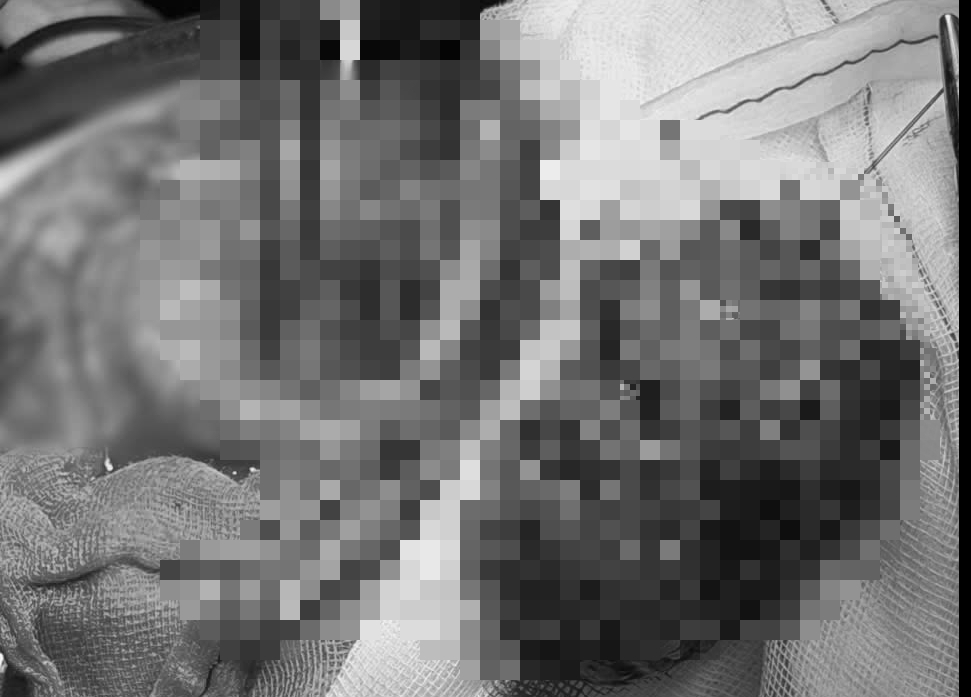 Nhức đầu k&eacute;o d&agrave;i, đi kh&aacute;m mới biết c&oacute; khối u lớn bằng quả cam - Ảnh 2.