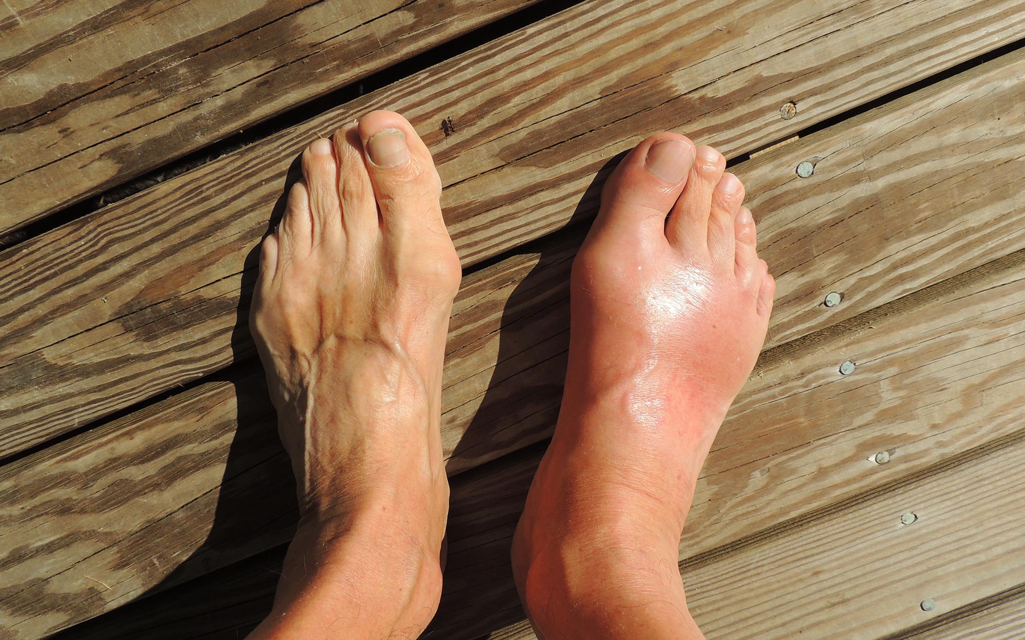 Phương pháp mới hứa hẹn trị cùng lúc bệnh gout và gan nhiễm mỡ