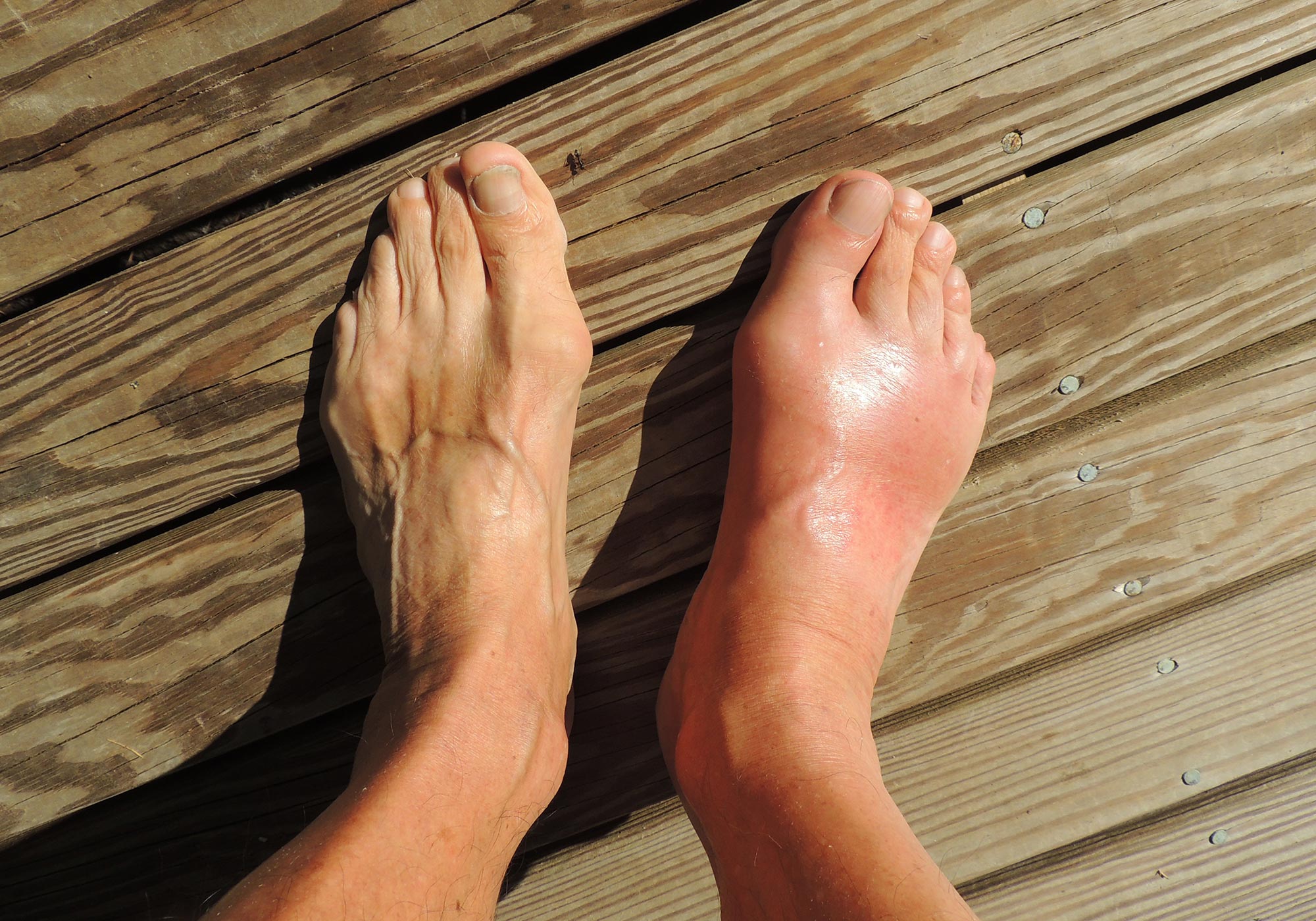 Phương pháp mới hứa hẹn trị cùng lúc bệnh gout và gan nhiễm mỡ - Ảnh 1.