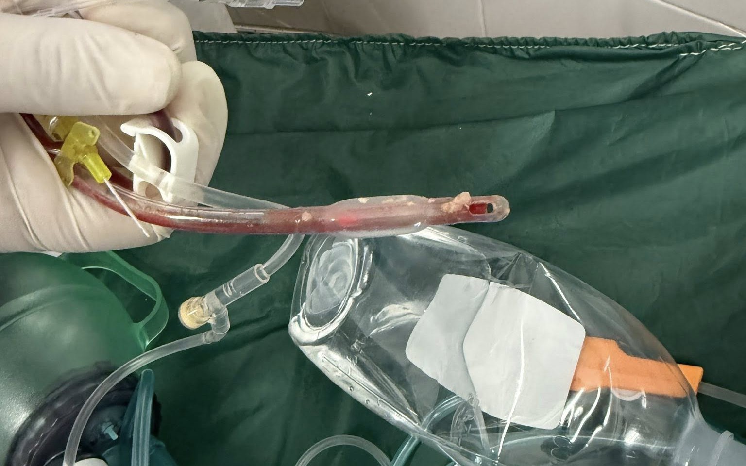 Bác sĩ cấp cứu đau lòng trước bé gái 3 tuổi sặc thức ăn ở nhà trẻ