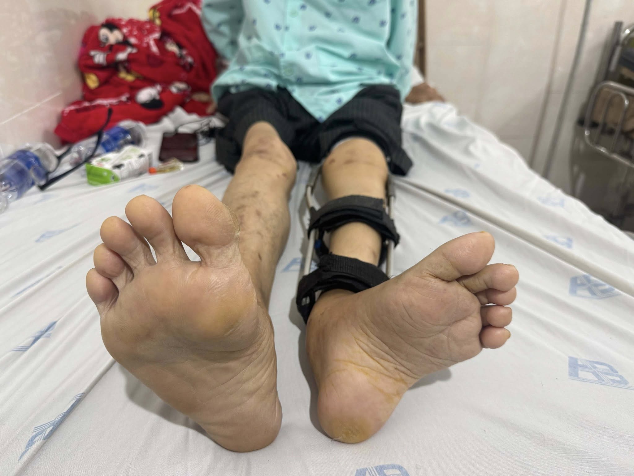 Thay khớp h&aacute;ng cho người đ&agrave;n &ocirc;ng bị bại liệt hơn 55 năm - Ảnh 1.