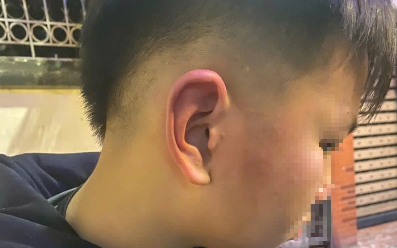 Phân định pháp lý vụ bé trai 12 tuổi bị bố bạn tát, đánh vào đầu