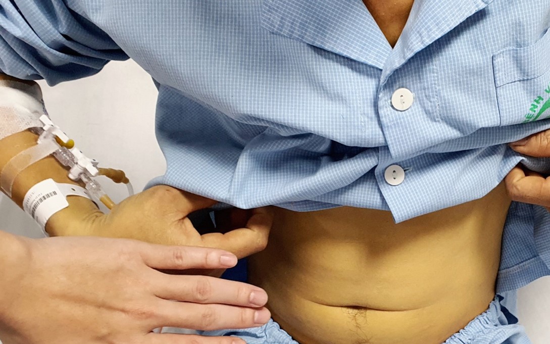 Uống mật cá trắm để tăng sinh lực, người đàn ông 38 tuổi nguy kịch