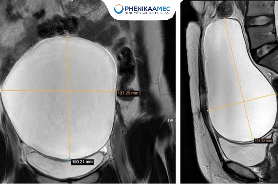 PhenikaaMec phẫu thuật th&agrave;nh c&ocirc;ng u nang buồng trứng 15cm - Ảnh 1.