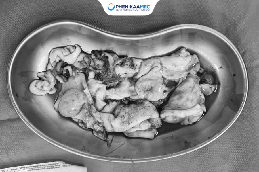 PhenikaaMec phẫu thuật th&agrave;nh c&ocirc;ng u nang buồng trứng 15cm - Ảnh 2.
