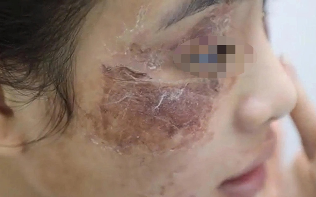 Cô gái bị tàn phá dung nhan vì bôi kem mua trên mạng