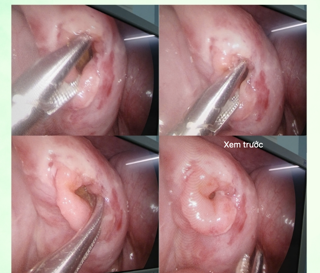 Tai nạn xe đạp điện, bé trai 6 tuổi nguy kịch vì vỡ ruột - Ảnh 1.