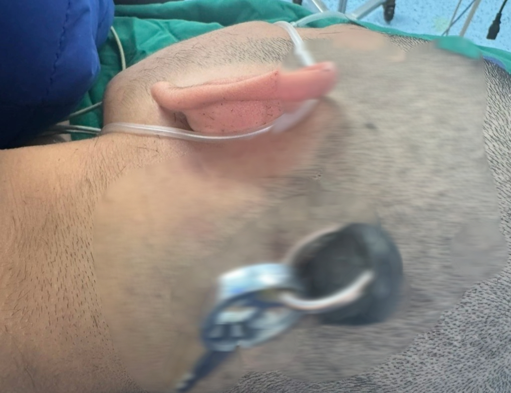 Đ&ugrave;a nghịch tr&ecirc;n lớp, nam sinh bị ch&igrave;a kh&oacute;a cắm s&acirc;u v&agrave;o đầu- Ảnh 1.