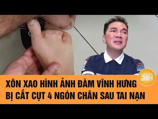Ca sĩ Đ&agrave;m Vĩnh Hưng phải cắt cụt 4 ng&oacute;n ch&acirc;n l&agrave; thật

- Ảnh 2.