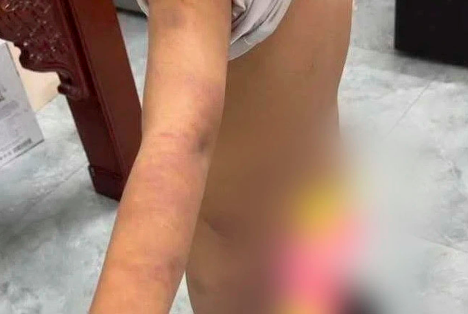 Làm rõ nghi vấn nam sinh lớp 6 bị bạo hành với nhiều vết bầm tím trên cơ thể- Ảnh 1.