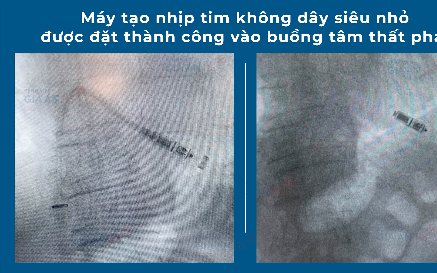 Đặt máy siêu nhỏ như thuốc con nhộng vào tim cứu người