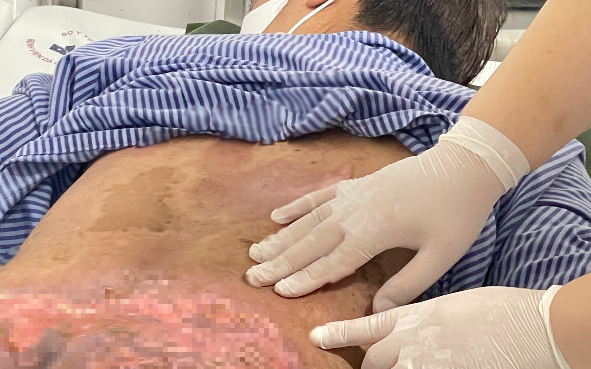 Chữa ngứa bằng hơn 40 con kiến ba khoang, nam thanh niên nhập viện