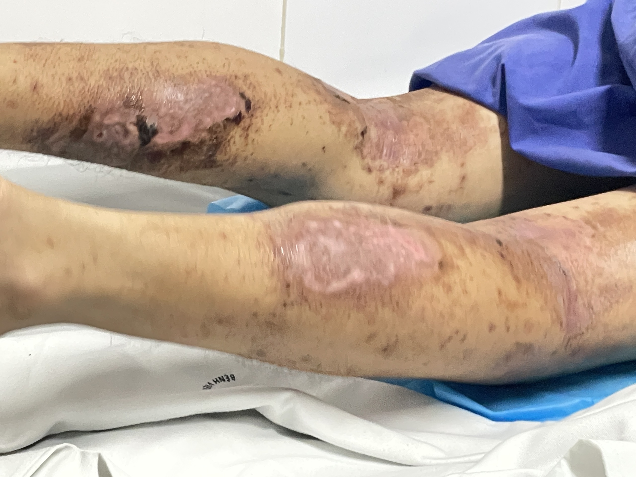 Chữa ngứa bằng hơn 40 con kiến ba khoang, nam thanh niên nhập viện- Ảnh 2.