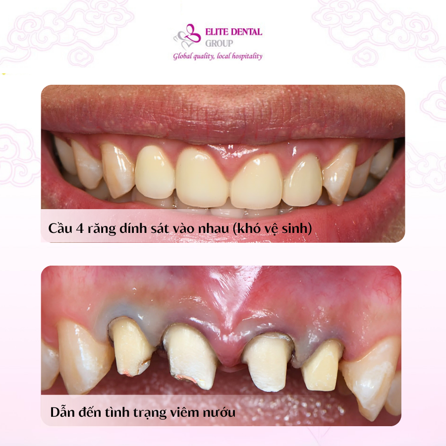 Cẩn trọng với răng sứ viêm nhiễm- Ảnh 1.
