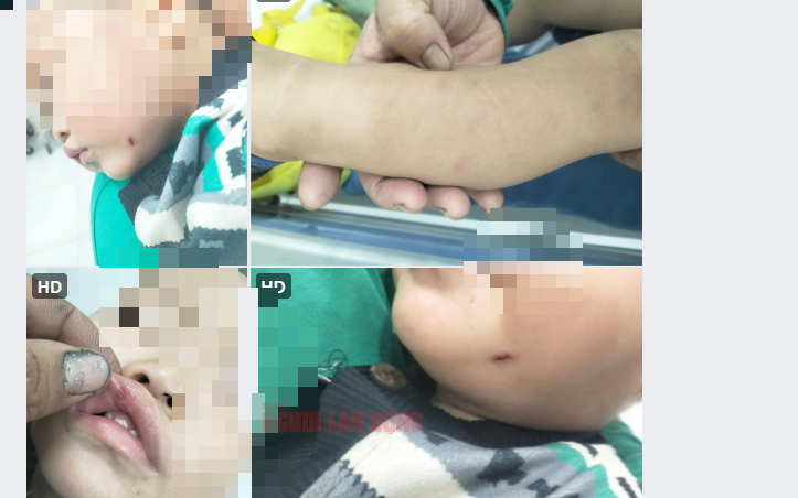 Nữ giáo viên đánh trẻ dã man: Kết quả điều tra ban đầu từ Công an Quảng Nam