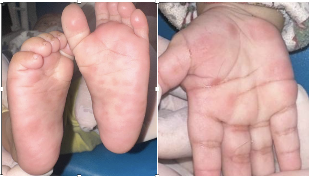 Bé trai 4 tháng tuổi mắc giang mai- Ảnh 1.