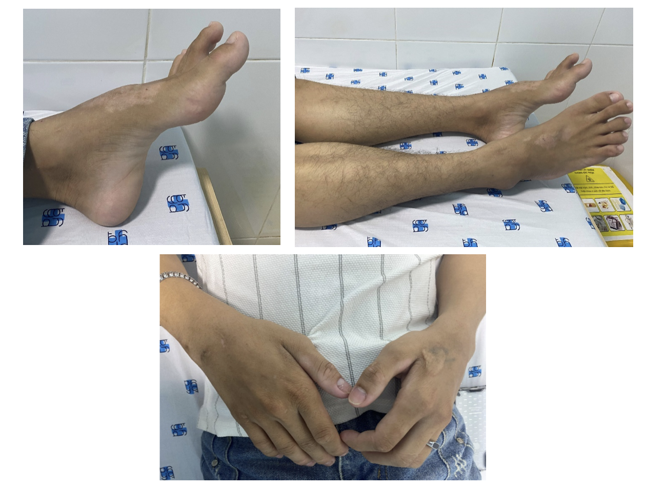 Ph&aacute;t hiện bệnh hiếm v&igrave; t&ecirc; yếu tay ch&acirc;n k&eacute;o d&agrave;i sau nhiều năm chẩn đo&aacute;n nhầm - Ảnh 1.