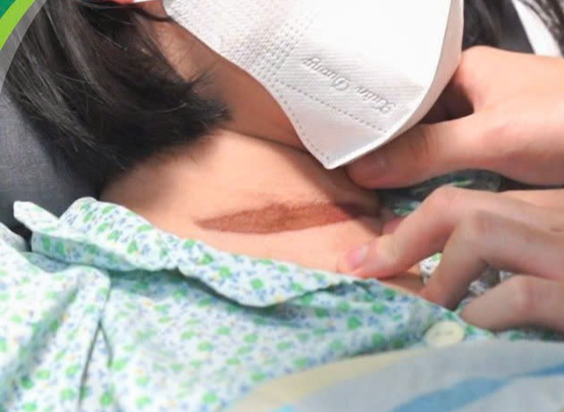 Bị cửa cuốn tại nh&agrave; kẹp cổ, b&eacute; g&aacute;i 11 tuổi ngừng tuần ho&agrave;n, nguy kịch- Ảnh 2.