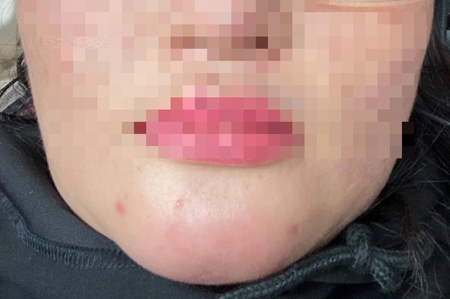 Người đàn ông mù mắt sau tiêm filler xóa nhăn "thế hệ mới"- Ảnh 2.