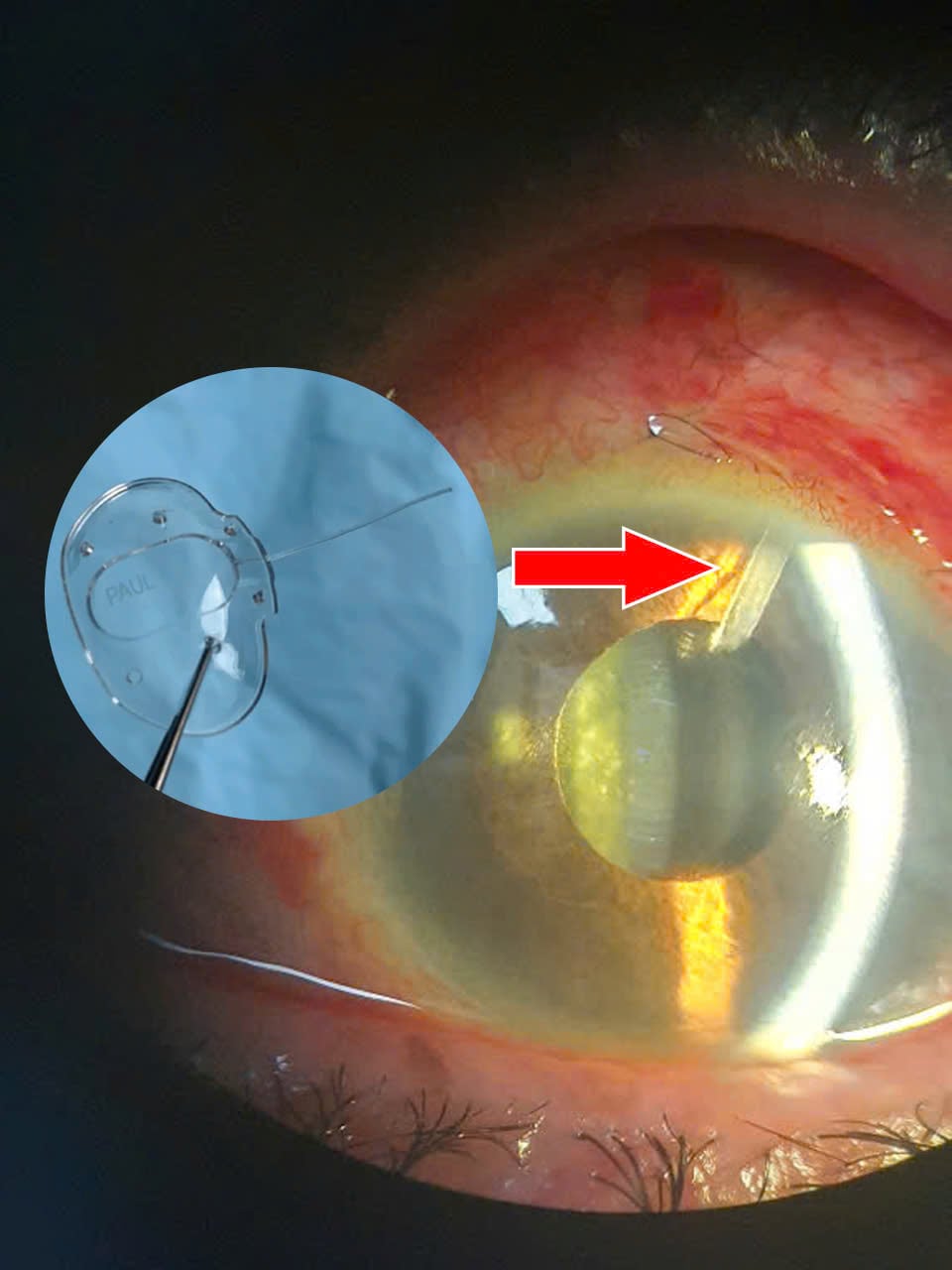 Ca đặt Paul Glaucoma Implant thứ hai, mở ra hy vọng mới cho bệnh nhân glaucoma- Ảnh 2.